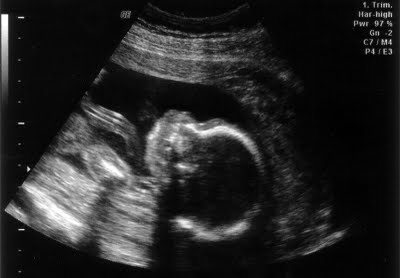 Ultrasound - Our little guy
